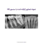 سنسور RVG واتک Vatech سایز 1.5 مدل EZ Sensor HD - Image 4